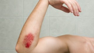 挫伤男人的胳膊