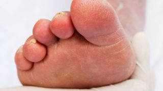 特写一个人的脚底和脚趾甲动脉硬化