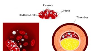 血液凝块的2D医疗插图