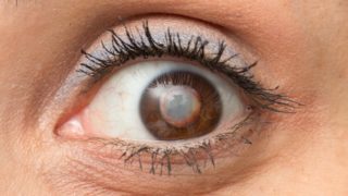 人眼白内障聚焦图像