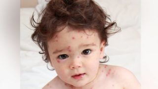 一个患水痘的小婴儿坐在床上