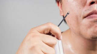 近距离的一个男人与堵塞的毛孔在他的脸上持有黑头萃取器