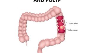 在白色背景上的结肠癌的二维医学图示
