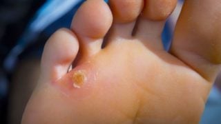 脚底上的鸡眼和老茧