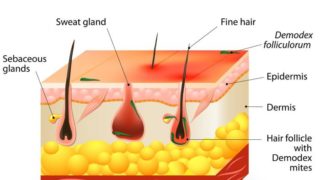信息图表显示demodicosis
