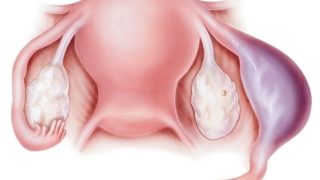 示出异位妊娠的图形