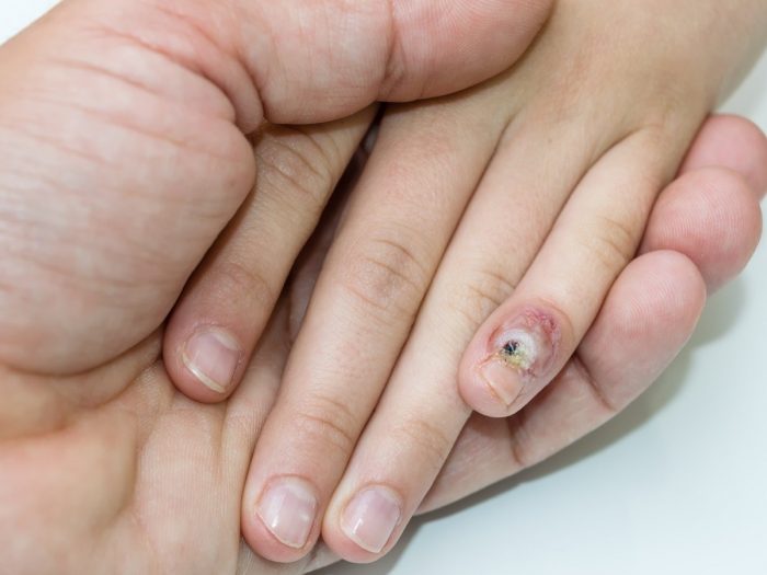 A flat wart found on a boy's little finger suffering from human papillomavirus