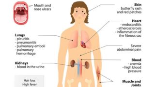 狼疮人体苦难的说明