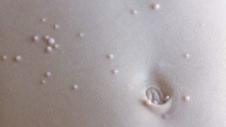 关闭在腹部的软体动物contagiosum