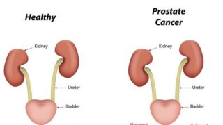 前列腺癌的二维医学图示