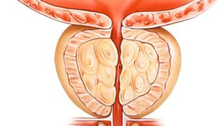 前列腺癌的图示。
