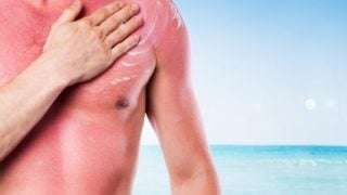 一个男人在被晒伤的胸部皮肤上涂了一层霜