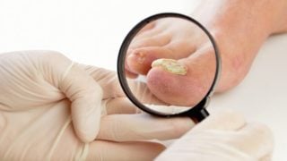 特写从趾甲真菌感染的检查左脚痛苦的形象