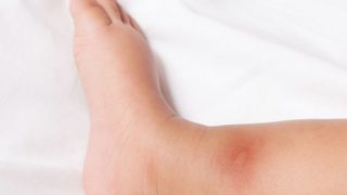 被蚊子咬伤的孩子的脚(被西尼罗病毒感染)