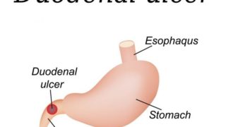8个治疗十二指肠炎的神奇家庭疗法