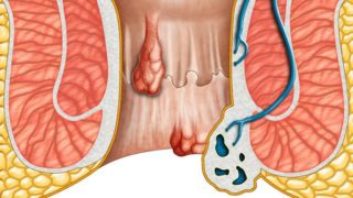 显示痔疮的医学插图