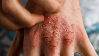 人的手的特写镜头有牛皮癣的