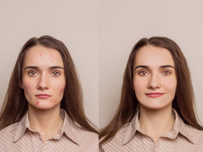 痤疮治疗程序前后的女人的脸