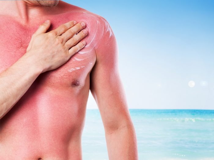 一个男人对他的胸部晒伤影响的皮肤申请霜